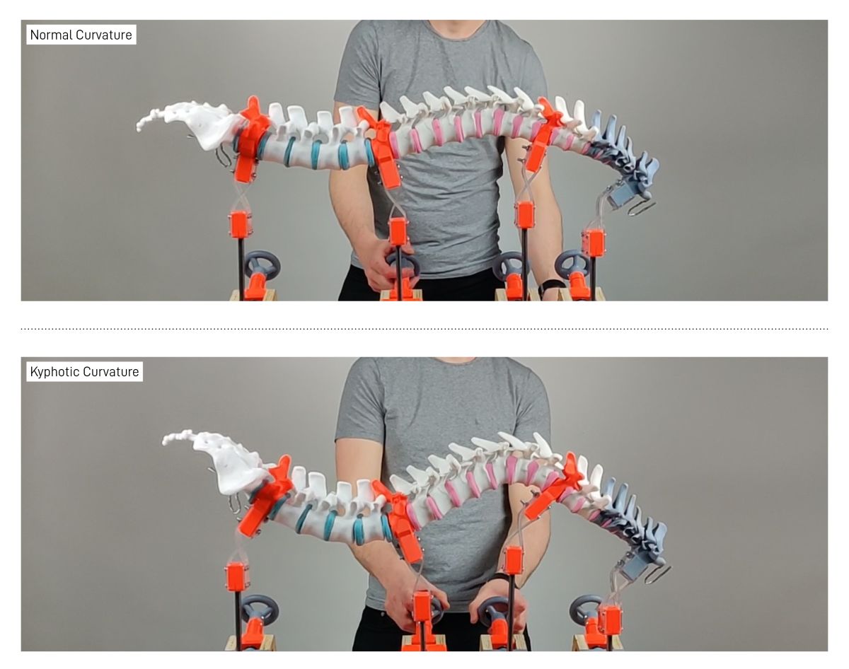 Re-Form allows the surgeon to create severe deformities